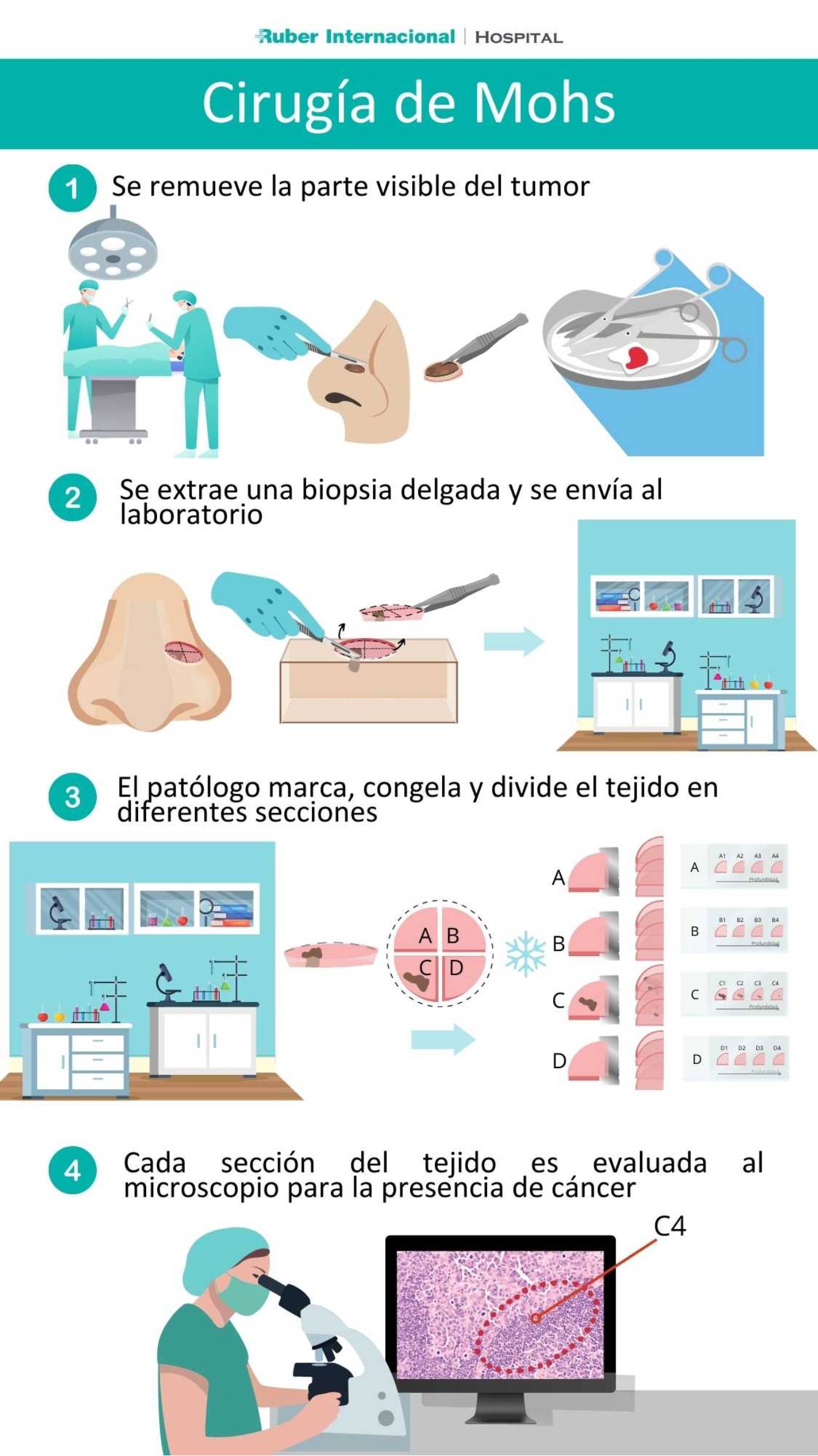 Cirugía De Mohs Tratamiento De Cáncer De Piel